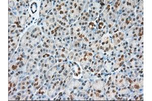 Immunohistochemical staining of paraffin-embedded Adenocarcinoma of Human colon tissue using anti-USP5 mouse monoclonal antibody. (USP5 anticorps)