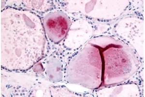 Human Thyroid (formalin-fixed, paraffin-embedded) stained with PDE8B antibody ABIN213535 at 10 ug/ml followed by biotinylated goat anti-rabbit IgG secondary antibody ABIN481713, alkaline phosphatase-streptavidin and chromogen.