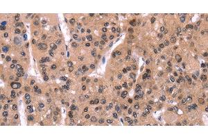 Immunohistochemistry of paraffin-embedded Human liver cancer using ARC Polyclonal Antibody at dilution of 1:50