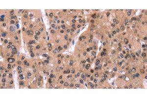 Immunohistochemistry of paraffin-embedded Human liver cancer using ARC Polyclonal Antibody at dilution of 1:50 (ARC anticorps)