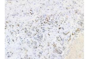 ABIN6256428 and ABIN6267317 at 1/100 staining human gastric carcinoma by IHC-P. (Retinoblastoma Protein (Rb) anticorps  (pSer807))