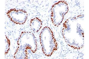 Formalin-fixed, paraffin-embedded human Prostate Cancer stained with p63 Rabbit Monoclonal Antibody (TP63/1423R). (p63 anticorps)