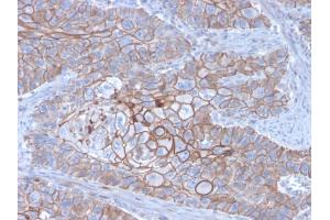 Formalin-fixed, paraffin-embedded human Breast Carcinoma stained with E-Cadherin Mouse Monoclonal Antibody (CDH1/3256).