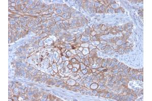Formalin-fixed, paraffin-embedded human Breast Carcinoma stained with E-Cadherin Mouse Monoclonal Antibody (CDH1/3256). (E-cadherin anticorps  (AA 567-691))