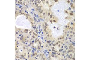 Immunohistochemistry of paraffin-embedded human oophoroma using MCM3 antibody (ABIN5970419) at dilution of 1/100 (40x lens). (MCM3 anticorps)