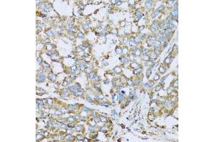Immunohistochemistry of paraffin-embedded human liver cancer using COX6A1 antibody. (COX6A1 anticorps)