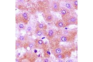 Immunohistochemical analysis of CBLB staining in human liver cancer formalin fixed paraffin embedded tissue section. (Cbl Proto-Oncogene B, E3 Ubiquitin Protein Ligase (CBLB) anticorps)