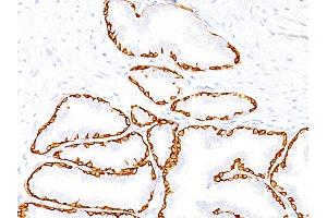 Formalin-fixed, paraffin-embedded human Prostate Carcinoma stained with Cytokeratin 14 Monoclonal Antibody (SPM263).