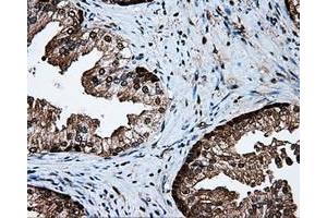 Immunohistochemical staining of paraffin-embedded Carcinoma of liver tissue using anti-PSMC3 mouse monoclonal antibody. (PSMC3 anticorps)