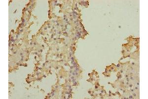 Immunohistochemistry of paraffin-embedded human breast cancer using ABIN7170508 at dilution of 1:100 (SOHLH2 anticorps  (AA 1-225))