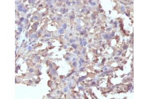 IHC staining of FFPE human histiocytoma with recombinant TNF alpha antibody (clone RMTNFA-1).