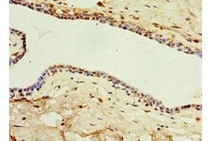 Immunohistochemistry of paraffin-embedded human breast cancer using ABIN7156854 at dilution of 1:100 (IL22 Receptor alpha 1 anticorps  (AA 16-230))