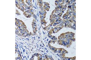 Immunohistochemistry of paraffin-embedded human gastric cancer using ATP5B antibody (ABIN5973391) at dilution of 1/100 (40x lens). (ATP5B anticorps)