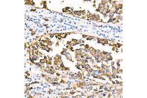 Immunohistochemistry of paraffin-embedded Human anaplastic large cell lymphoma using CD20 antibody (ABIN7268472) at dilution of 1:100 (40x lens). (CD20 anticorps)