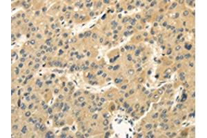 The image on the left is immunohistochemistry of paraffin-embedded Human liver cancer tissue using ABIN7130214(MED16 Antibody) at dilution 1/30, on the right is treated with fusion protein. (MED16 anticorps)