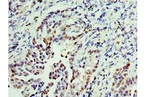 Immunohistochemistry of paraffin-embedded human lung cancer using ABIN7156290 at dilution of 1:100 (IMPDH2 anticorps  (AA 215-514))
