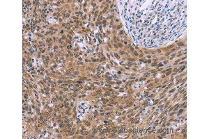 Immunohistochemistry of Human liver cancer using GLYR1 Polyclonal Antibody at dilution of 1:30 (GLYR1 anticorps)