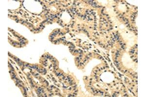 The image on the left is immunohistochemistry of paraffin-embedded Human thyroid cancer tissue using ABIN7130214(MED16 Antibody) at dilution 1/30, on the right is treated with fusion protein. (MED16 anticorps)