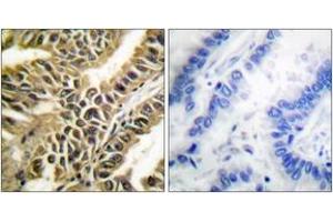 Immunohistochemistry analysis of paraffin-embedded human lung carcinoma tissue, using Abl (Ab-412) Antibody. (ABL1 anticorps  (AA 361-410))