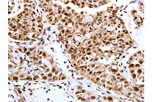 The image on the left is immunohistochemistry of paraffin-embedded Human lung cancer tissue using ABIN7193127(Map2 Antibody) at dilution 1/40, on the right is treated with synthetic peptide. (MAP2 anticorps)