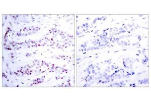 Immunohistochemical analysis of paraffin-embedded human breast carcinoma tissue using STAT6 (Ab-641) antibody (E021050). (STAT6 anticorps)