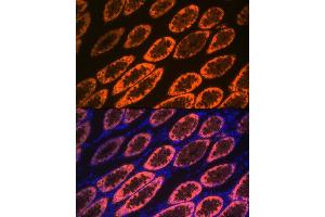 Immunofluorescence analysis of human colon carcinoma using Galectin 4/LG Rabbit mAb (ABIN1679347, ABIN3017979, ABIN3017980 and ABIN7101554) at dilution of 1:100 (40x lens).