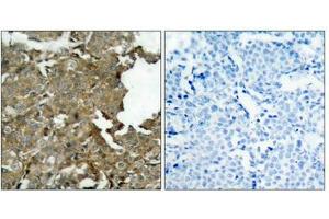 Immunohistochemical analysis of paraffin-embedded human breast carcinoma tissue using cofilin(Ab-3) Antibody(left) or the same antibody preincubated with blocking peptide(right).