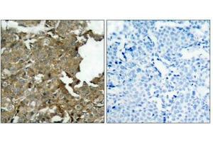 Immunohistochemical analysis of paraffin-embedded human breast carcinoma tissue using cofilin(Ab-3) Antibody(left) or the same antibody preincubated with blocking peptide(right). (Cofilin anticorps  (AA 1-5))
