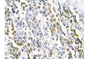 Immunohistochemistry analyzes of MRE11 antibody in paraffin-embedded human lung carcinoma tissue. (Mre11 anticorps)