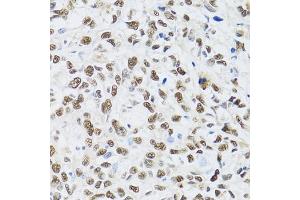 Immunohistochemistry of paraffin-embedded human liver cancer using MT antibody (ABIN6128251, ABIN6144117, ABIN6144118 and ABIN6222360) at dilution of 1:100 (40x lens).
