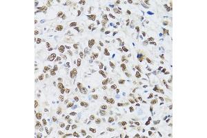 Immunohistochemistry of paraffin-embedded human liver cancer using MT antibody (ABIN6128251, ABIN6144117, ABIN6144118 and ABIN6222360) at dilution of 1:100 (40x lens). (MTA3 anticorps  (AA 40-330))