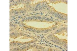 Immunohistochemistry of paraffin-embedded human endometrial cancer using ABIN7142784 at dilution of 1:100 (RPL26L1 anticorps  (AA 1-145))