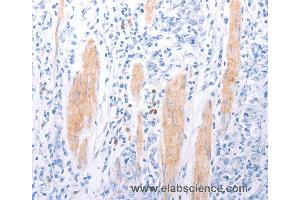 Immunohistochemistry of Human gastic cancer using LPAR2 Polyclonal Antibody at dilution of 1:40