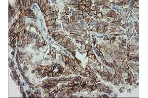 Immunohistochemical staining of paraffin-embedded Adenocarcinoma of Human ovary tissue using anti-CDH2 mouse monoclonal antibody. (N-Cadherin anticorps)