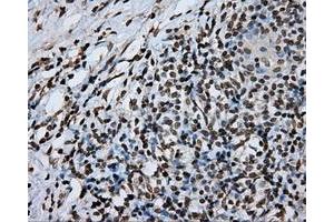 Immunohistochemical staining of paraffin-embedded Adenocarcinoma of ovary tissue using anti-DAPK2 mouse monoclonal antibody. (DAPK2 anticorps)