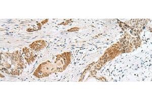 Immunohistochemistry of paraffin-embedded Human esophagus cancer tissue using HIST1H2BK Polyclonal Antibody at dilution of 1:40(x200) (HIST1H2BK anticorps)