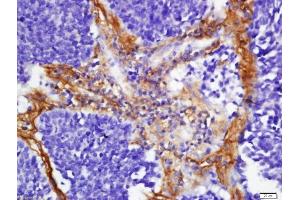 Formalin-fixed and paraffin embedded human lung carcinoma labeled with Anti-FHOD1 Polyclonal Antibody, Unconjugated  at 1:200 followed by conjugation to the secondary antibody and DAB staining (FHOD1 anticorps  (AA 601-700))