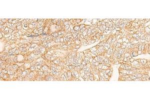 Immunohistochemistry of paraffin-embedded Human gastric cancer tissue using KRT9 Polyclonal Antibody at dilution of 1:30(x200) (KRT9 anticorps)