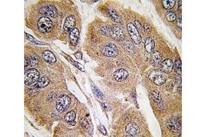 IHC analysis of FFPE human breast carcinoma tissue stained with p70S6K antibody