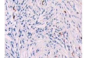 Detection of PF4 in Human Pancreatic cancer Tissue using Polyclonal Antibody to Platelet Factor 4 (PF4) (PF4 anticorps  (AA 31-101))