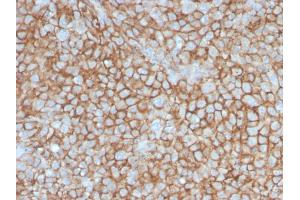 Formalin-fixed, paraffin-embedded human Melanoma stained with MCAM Mouse Monoclonal Antibody (MCAM/3046).