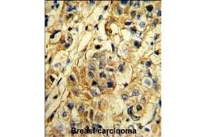 Formalin-fixed and paraffin-embedded human breast carcinoma reacted with TI Antibody (N-term), which was peroxidase-conjugated to the secondary antibody, followed by DAB staining.