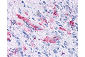 Anti-MRGD / MRGPRD antibody IHC of human Brain, Glioblastoma. (MRGPRD anticorps  (Cytoplasmic Domain))