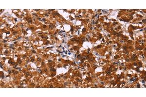 Immunohistochemistry of paraffin-embedded Human thyroid cancer tissue using ART5 Polyclonal Antibody at dilution 1:50 (ART5 anticorps)