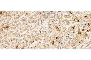 Immunohistochemistry of paraffin-embedded Human gastric cancer tissue using TBCK Polyclonal Antibody at dilution of 1:25(x200)