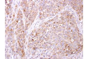 IHC-P Image ETNK1 antibody [N2C3] detects ETNK1 protein at cytosol on H358 xenograft by immunohistochemical analysis.