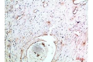 Immunohistochemical analysis of paraffin-embedded human-cervical-cancer, antibody was diluted at 1:200