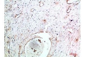 Immunohistochemical analysis of paraffin-embedded human-cervical-cancer, antibody was diluted at 1:200 (TNIP2 anticorps  (AA 61-110))