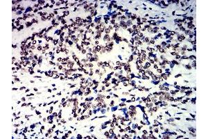 Immunohistochemical analysis of paraffin-embedded esophageal cancer tissues using NAGR1 mouse mAb with DAB staining.