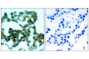 Immunohistochemical analysis of paraffin-embedded human lung carcinoma tissue, using PKCβ (Ab-641) antibody (E021184). (PKC beta anticorps)